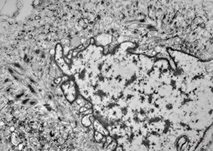 M,3m. | rhabdomyosarcoma in retented testis